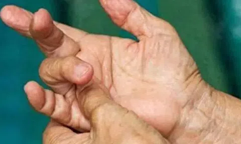 4 thay đổi ở ngón tay có thể là dấu hiệu ung thư phổi, hãy đi khám ngay!