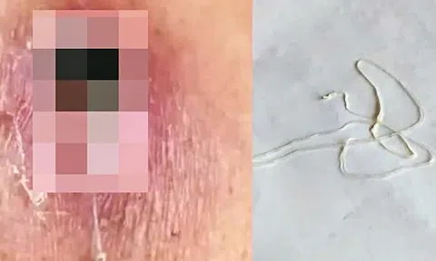 Người đàn ông 44 tuổi nhiễm loại ký sinh trùng hiếm gặp dài hàng mét