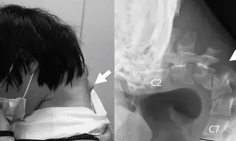 Nam thanh niên 25 tuổi không thể ngẩng đầu vì thói quen nhiều người trẻ mắc phải
