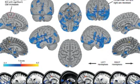 Quét não của 30 phi hành gia bằng MRI trước và sau khi bay vào vũ trụ, các chuyên gia có phát hiện sốc