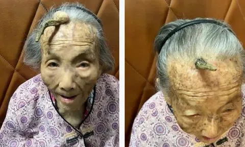 Cụ bà 107 tuổi bỗng mọc "sừng" trên trán, cộng đồng mạng bàn tán đưa ra lời khuyên