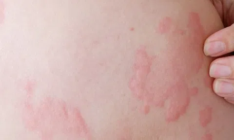 Bác sĩ chỉ ra sai lầm “chết người” về một căn bệnh mà nhiều người vẫn vô tư điều trị tại nhà