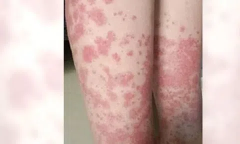 Nữ sinh trả giá đắt vì nhuộm tóc liên tục: Thận chảy máu, phải cạo đầu giữ mạng