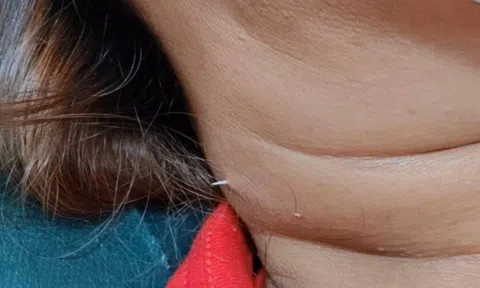 Đau cổ, người phụ nữ sốc nặng khi thấy thứ nhô ra ngoài