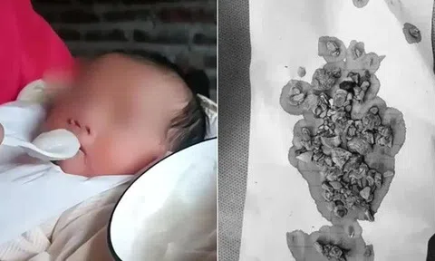 Bé gái 5 tháng tuổi đến viện với chiếc bụng toàn sỏi, bác sĩ kinh hoàng khi biết việc bố mẹ làm từ lúc bé mới sinh 3 ngày