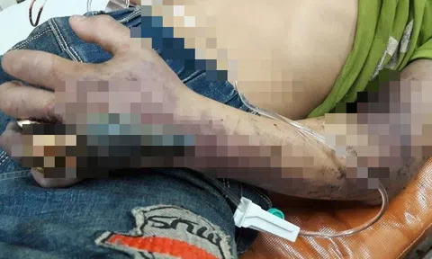 Bị rắn độc cắn, người đàn ông 50 tuổi tin thầy lang đắp thuốc lá "rước họa vào thân"