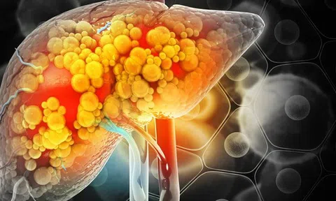 Phát hiện thói quen khiến gan "ngập" trong mỡ, nhiều người làm mỗi ngày: Không phải uống rượu bia