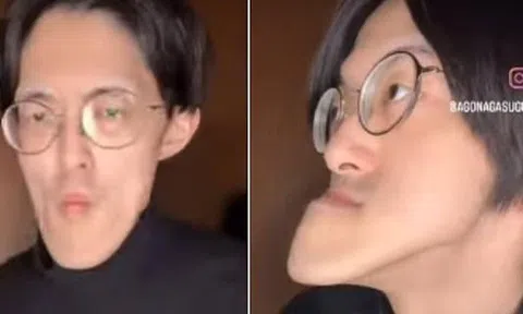 Người đàn ông có "chiếc cằm dài nhất thế giới", vẫn tiếp tục dài ra