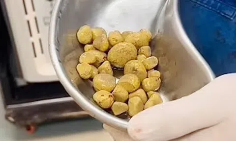 Phát hiện 35 viên sỏi trong bàng quang người đàn ông, "thủ phạm" là loại nước quen thuộc