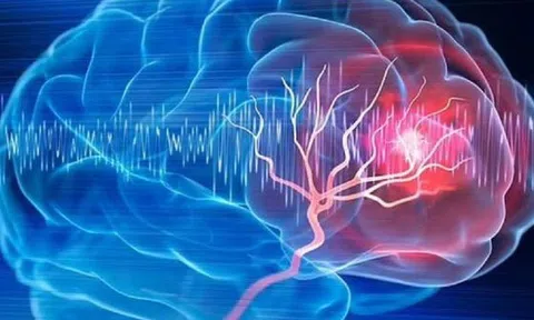 Người phụ nữ 57 tuổi bất ngờ phát hiện khối u não nhờ đồng hồ đeo tay
