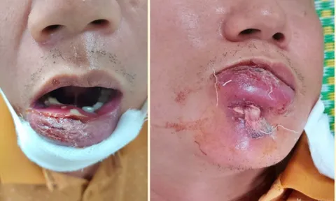 Người đàn ông 40 tuổi nhập viện với phần môi sưng tấy vì mắc sai lầm phổ biến