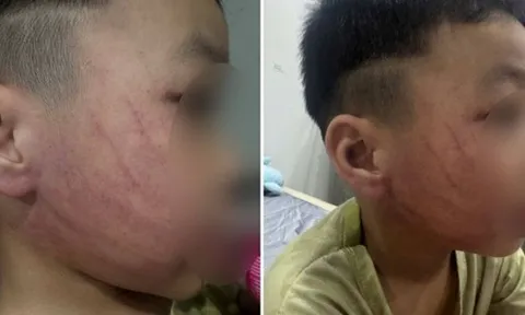 Xôn xao hình ảnh bé trai ở Hà Nội bị đánh tím mặt, phụ huynh phẫn nộ tố đích danh giáo viên