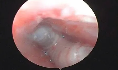 Thấy trẻ bị đau tai kèm chảy máu, gia đình đưa đi khám thì sốc nặng