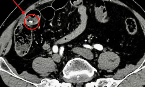 Khám cho cụ ông 86 tuổi, bác sĩ sốc nặng khi phát hiện "bí mật đáng sợ"