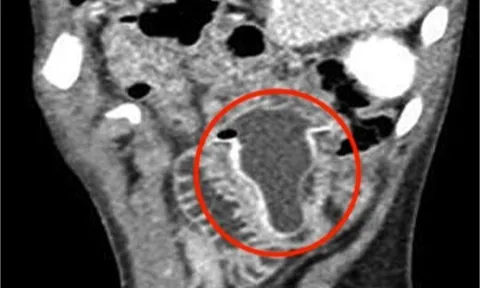 Bé trai 10 tuổi nôn mửa, đau bụng suốt 4 ngày, bác sĩ sốc nặng khi phát hiện "bí mật" đáng sợ