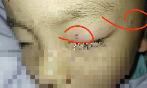 Cậu bé bị nhiễm trùng, mù một bên mắt vì hành động của giáo viên