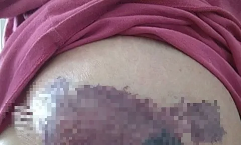 Người phụ nữ mới sinh ngực đột ngột chuyển màu đen, bác sĩ sốc nặng khi phát hiện "bí mật" đáng sợ