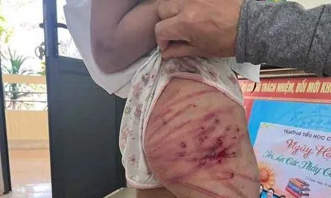 Xác minh thông tin bé gái nghi bị cha dượng bạo hành