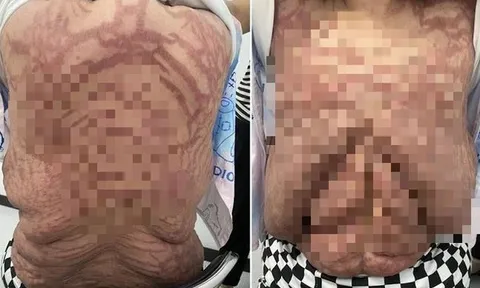 Người phụ nữ 40 tuổi, da biến dạng kinh hoàng vì sai lầm nhiều người mắc