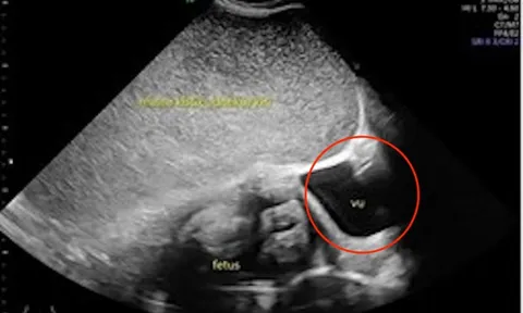 Thai phụ 26 tuổi kêu đau dạ dày, bác sĩ sốc nặng khi phát hiện "bí mật" đáng sợ