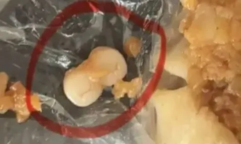 Người dân sốc nặng khi phát hiện răng người trong xúc xích, dimsum