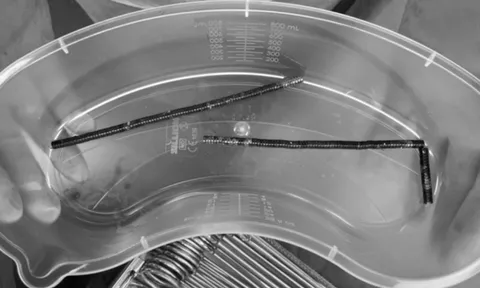 Bé trai 13 tuổi đau bụng dữ dội, bác sĩ phát hiện bí mật "đáng sợ" bên trong