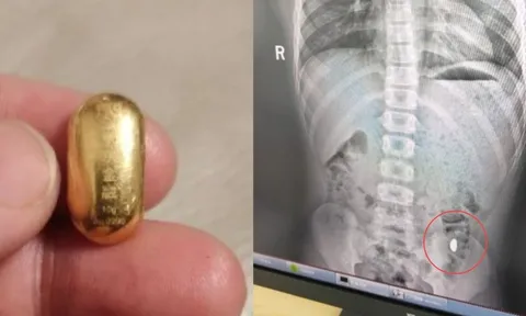 Con trai nuốt miếng vàng của mẹ vào bụng và cái kết