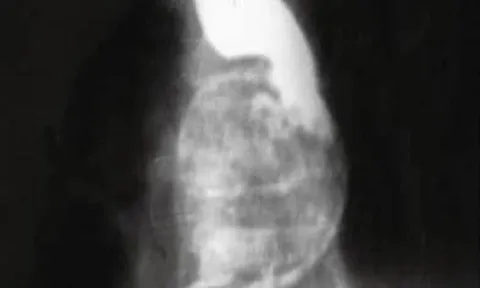 Người phụ nữ bị khó nuốt, bác sĩ phát hiện ra "bí mật" đáng sợ