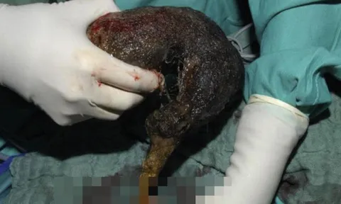 Bé gái đau bụng suốt 10 tháng, bác sĩ phát hiện ra "bí mật" đáng sợ