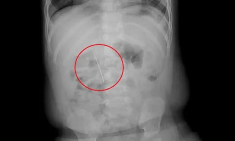 Bé trai 11 tháng khó chịu trong người, bác sĩ gắp ra thứ "đáng sợ"