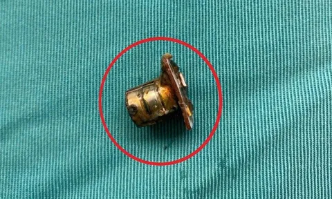 Bé 2 tuổi đang chơi bỗng ho tím tái, bác sĩ gắp ra thứ "đáng sợ" trong bụng