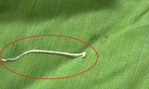 Đau bụng âm ỉ, đến viện bác sĩ gắp ra thứ "đáng sợ" bên trong