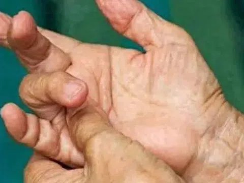 4 thay đổi ở ngón tay có thể là dấu hiệu ung thư phổi, hãy đi khám ngay!