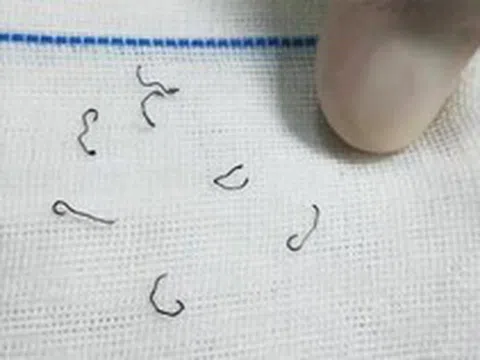 Sau khi cắt trĩ, người phụ nữ phải nhập viện nhổ đinh 8 lần suốt 10 năm