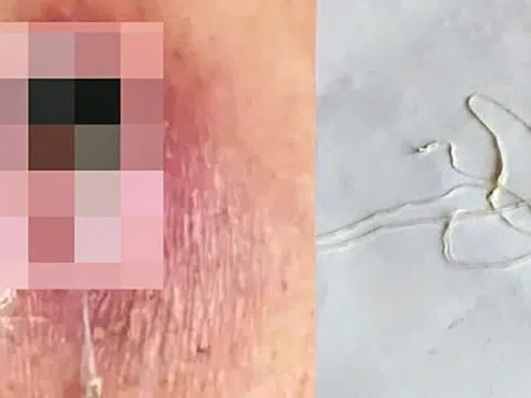 Người đàn ông 44 tuổi nhiễm loại ký sinh trùng hiếm gặp dài hàng mét