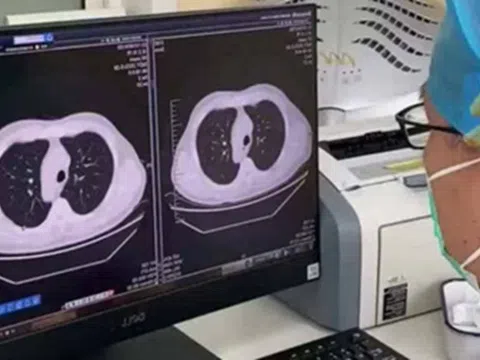 Cảm lạnh và ho, phổi trái của nam sinh đột nhiên "biến mất": Bác sĩ tiết lộ nguyên nhân nhiều người phải cẩn thận
