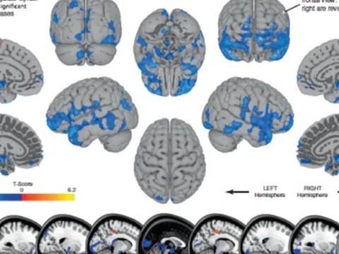 Quét não của 30 phi hành gia bằng MRI trước và sau khi bay vào vũ trụ, các chuyên gia có phát hiện sốc