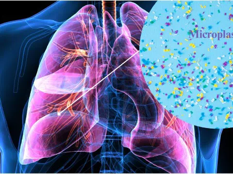 22 triệu hạt vi nhựa 'chui' vào cơ thể người bằng cách không ngờ tới: Làm ngay 7 điều để giảm nguy cơ
