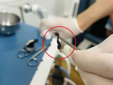 Thấy chảy máu mũi kéo dài, bé trai đến viện bác sĩ gắp ra thứ "đáng sợ"