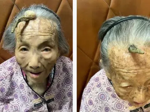 Cụ bà 107 tuổi bỗng mọc "sừng" trên trán, cộng đồng mạng bàn tán đưa ra lời khuyên