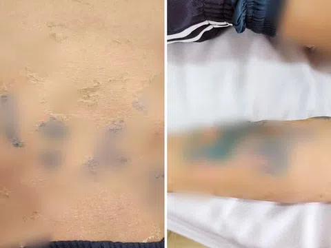 Tự đắp lá chữa bệnh sởi, nam thanh niên 17 tuổi nhập viện gấp