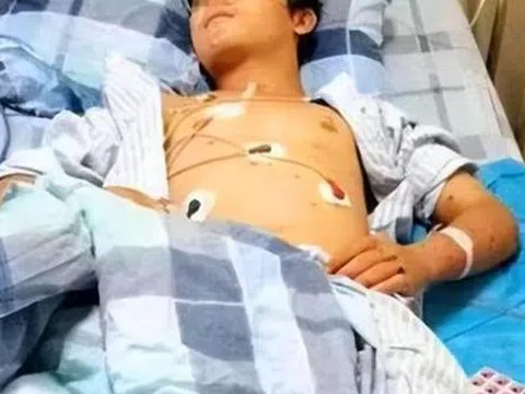 Chàng trai 17 tuổi suy thận giai đoạn cuối vì ăn quá nhiều 2 món nhưng vì "quá ngon" nên không ai từ chối