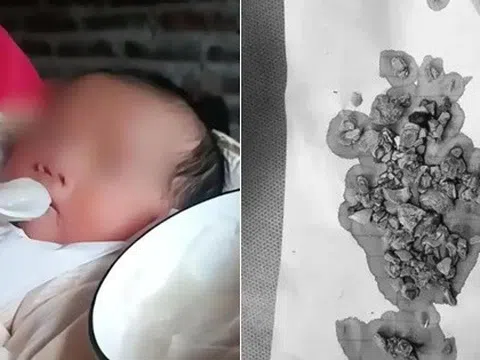 Bé gái 5 tháng tuổi đến viện với chiếc bụng toàn sỏi, bác sĩ kinh hoàng khi biết việc bố mẹ làm từ lúc bé mới sinh 3 ngày