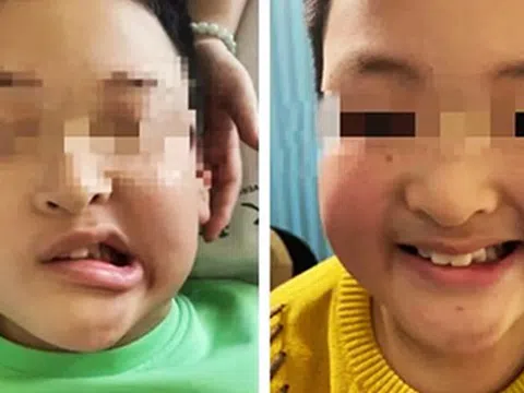 Bé trai 11 tuổi méo miệng do liệt dây thần kinh số VII, bác sĩ cảnh báo nguyên nhân thường gặp