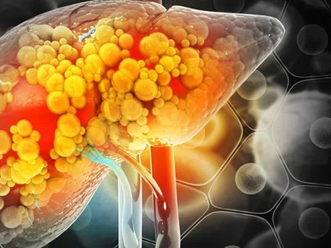 Phát hiện thói quen khiến gan "ngập" trong mỡ, nhiều người làm mỗi ngày: Không phải uống rượu bia