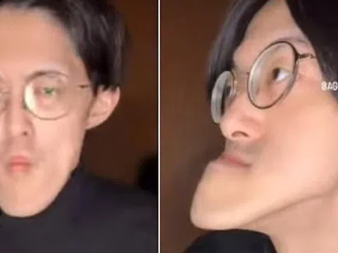 Người đàn ông có "chiếc cằm dài nhất thế giới", vẫn tiếp tục dài ra