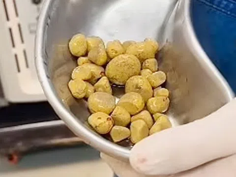 Phát hiện 35 viên sỏi trong bàng quang người đàn ông, "thủ phạm" là loại nước quen thuộc