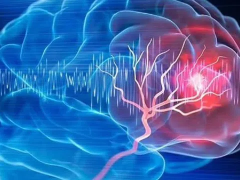 Người phụ nữ 57 tuổi bất ngờ phát hiện khối u não nhờ đồng hồ đeo tay