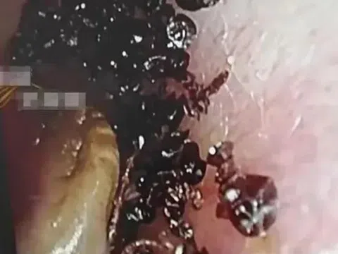 Bé gái 2 tuổi đi khám vì đau tai, bác sĩ phát hiện "bí mật đáng sợ"
