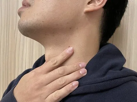 Uống 5 lon nước ngọt mỗi ngày, nam thanh niên trào ngược dạ dày 98 lần